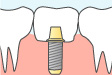 インプラント